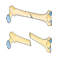 Broken femurs and late night birthday parties